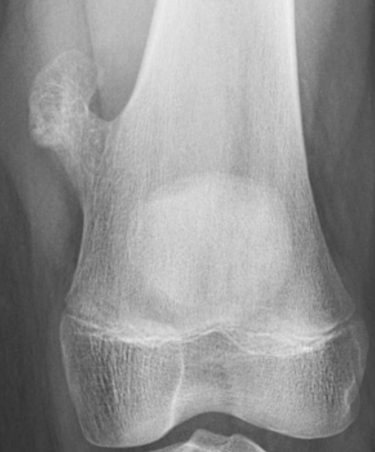 Osteocondroma