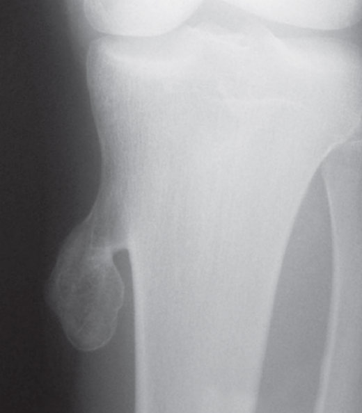 Radiografía que muestra un osteocondroma en la tibia
