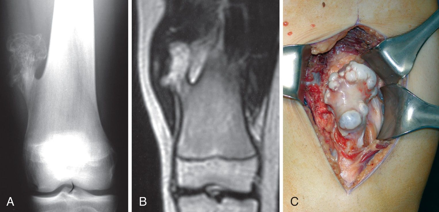 Osteocondroma visto en una radiografía, en una resonancia magnética y en vivo
