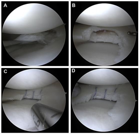 Sutura de rotura meniscal