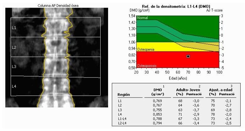 osteoporosis diagnosticada mediante densitometría