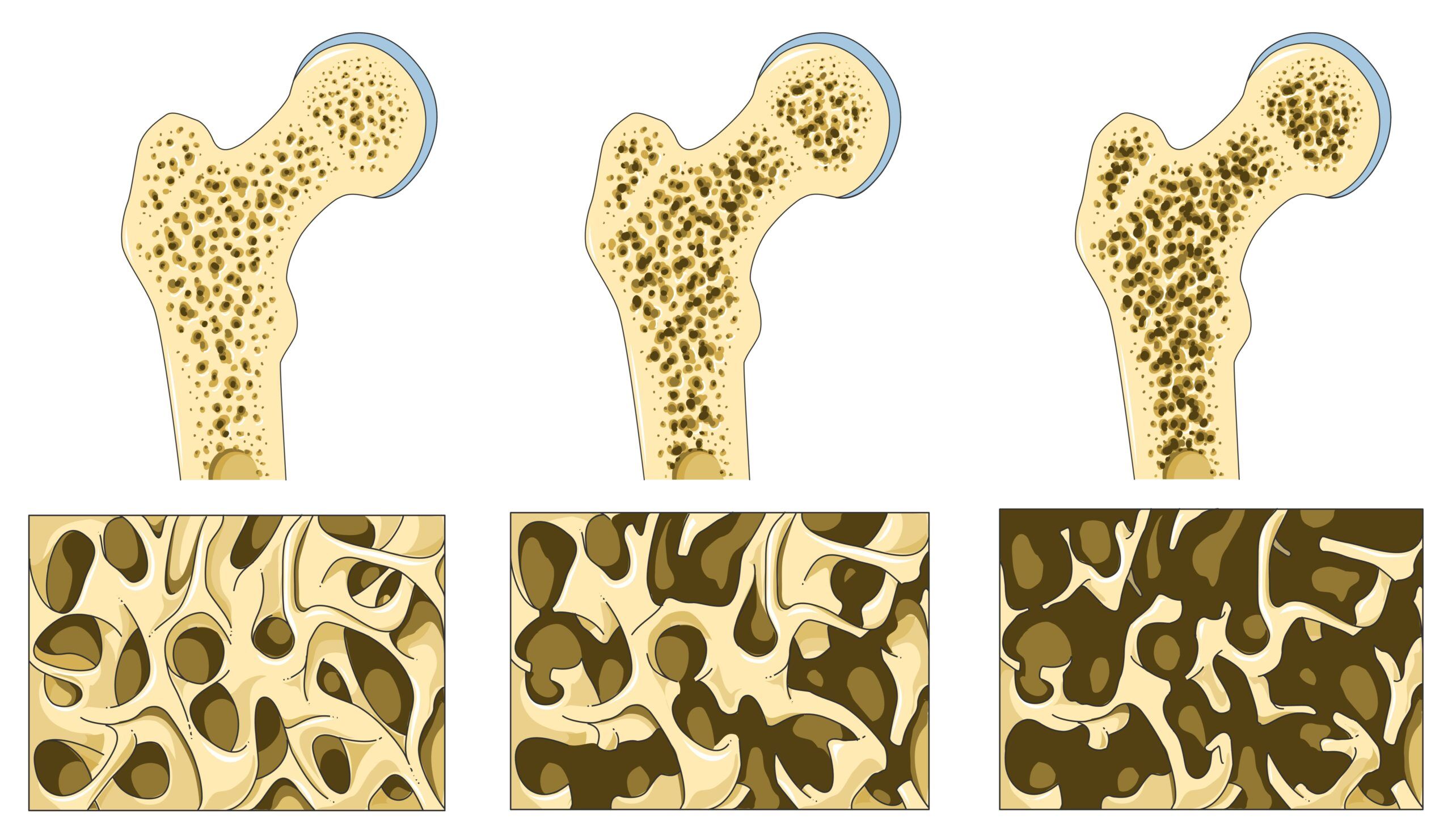 osteoporosis y sus distintos estados de evolución