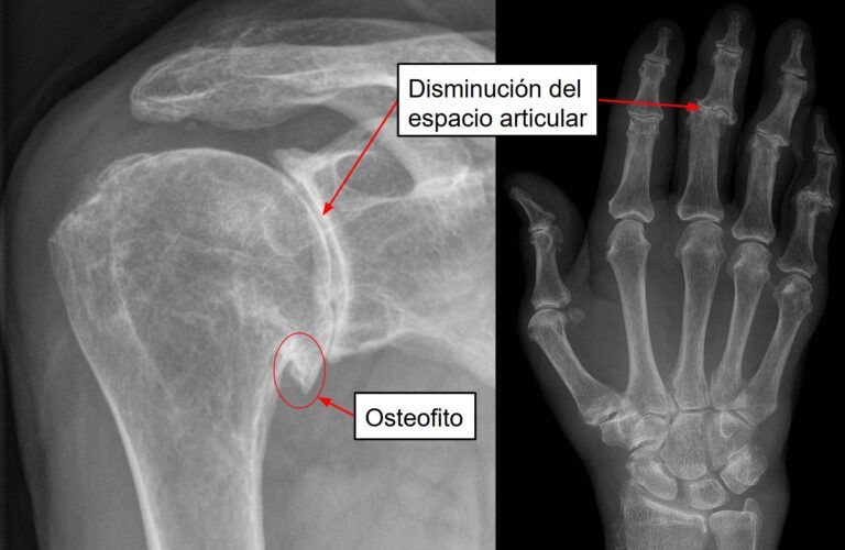 Artrosis de hombro y de mano en una radiografia que muestra los signos típicos de esta enfermedad.