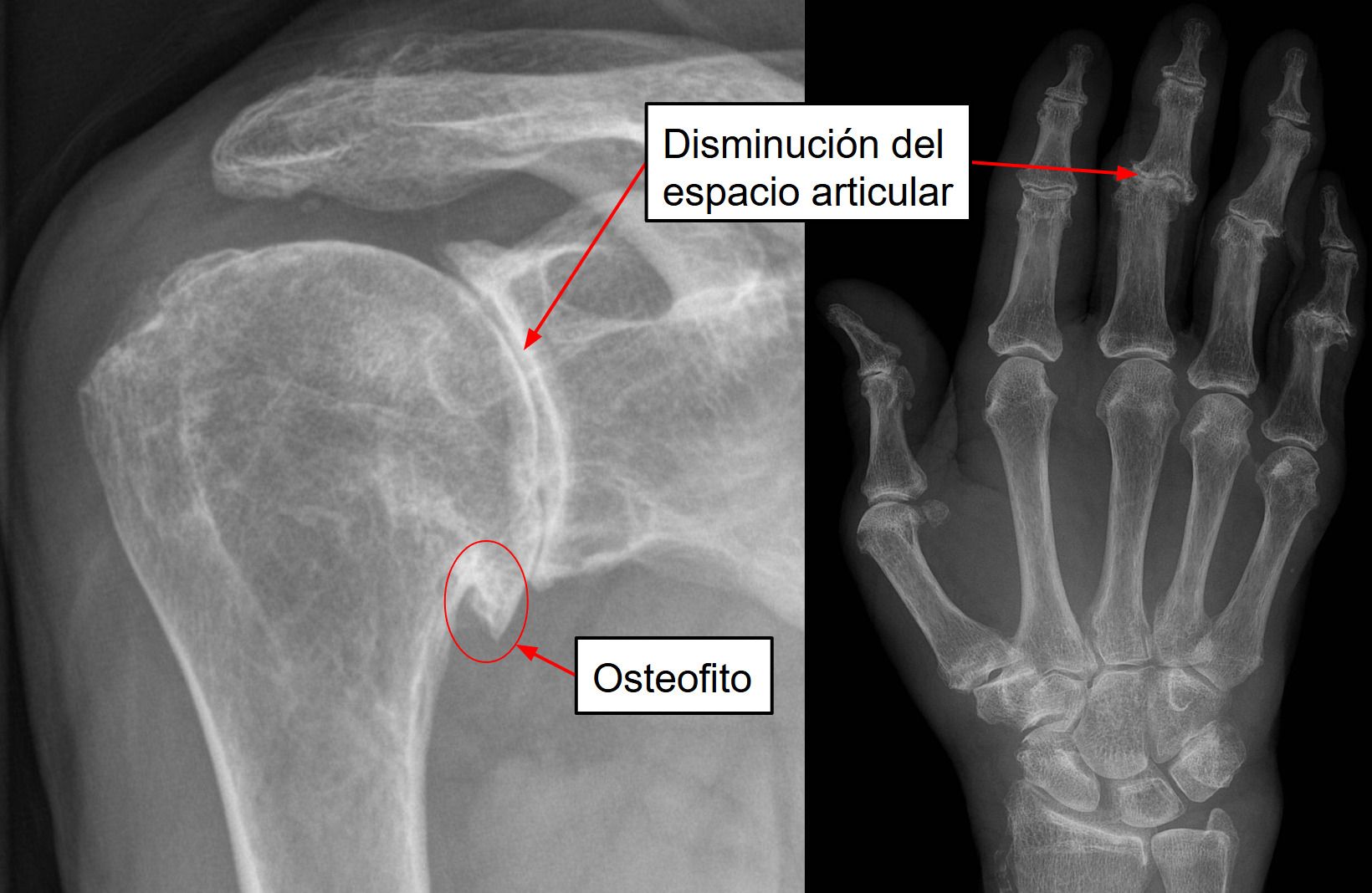 Artrosis de hombro y de mano en una radiografia que muestra los signos típicos de esta enfermedad.