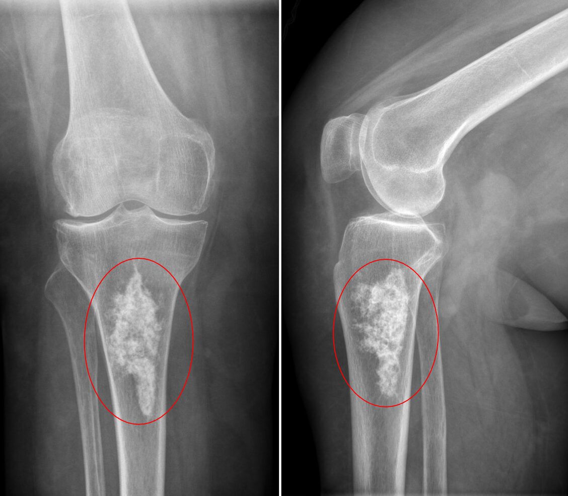 Encondroma en tibia proximal derecha