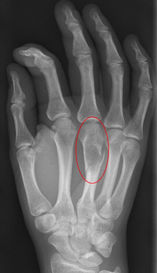 Encondroma en el tercer metacarpiano de la mano que produce una fractura patológica