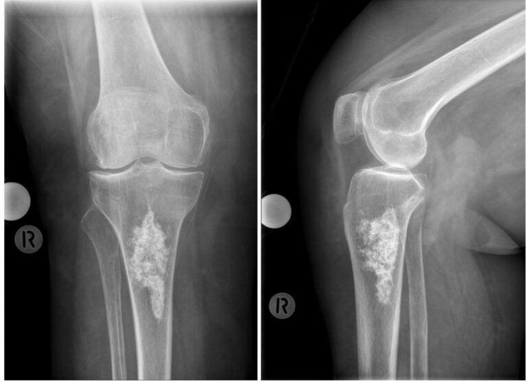 Encondroma en tibia proximal derecha