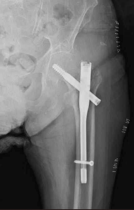 Fractura pertrocanterea de cadera operada con un clavo de femur