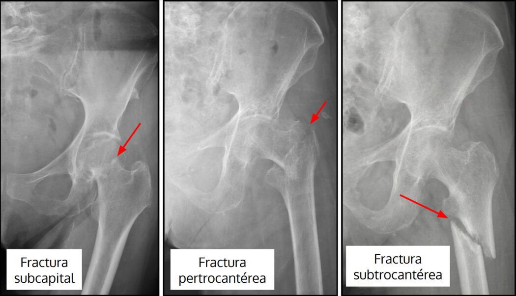 fractura-de-cadera-qu-es-tratamiento-y-recuperaci-n