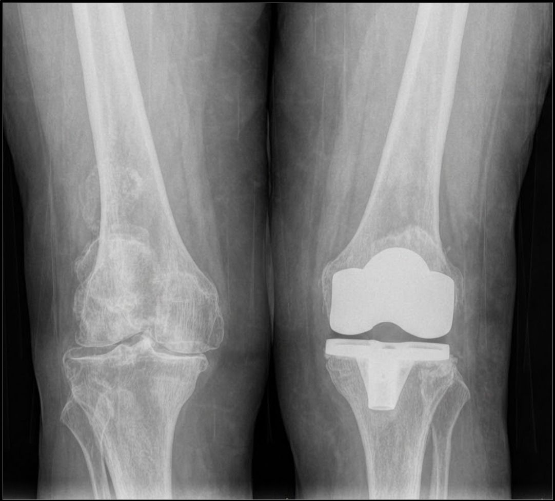Protesis de rodilla para artrosis de rodilla