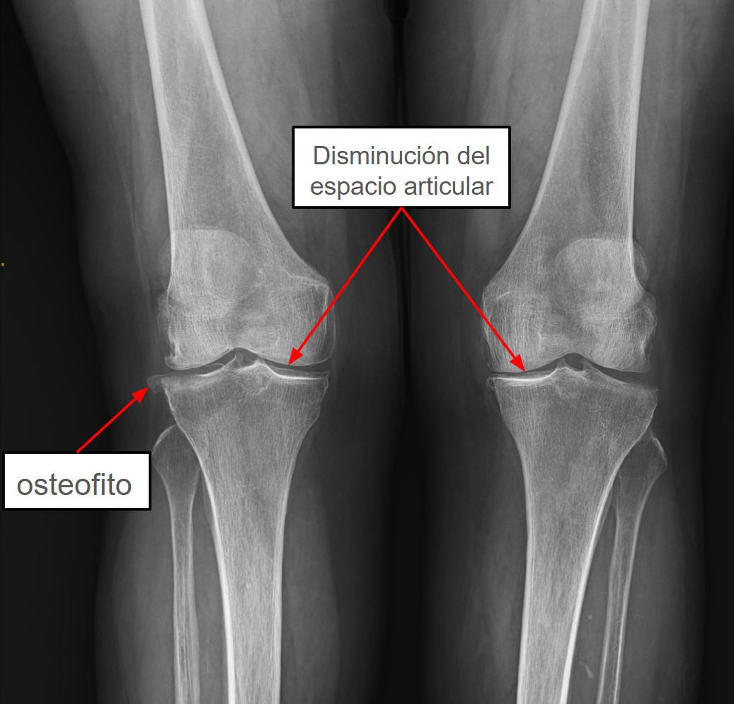 Radiografia de rodilla con artrosis se pueden apreciar ostefitos y disminucion del espacio articular