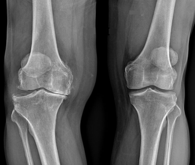 esclerosis subcondral y osteofitosis radiografia artrosis rodilla