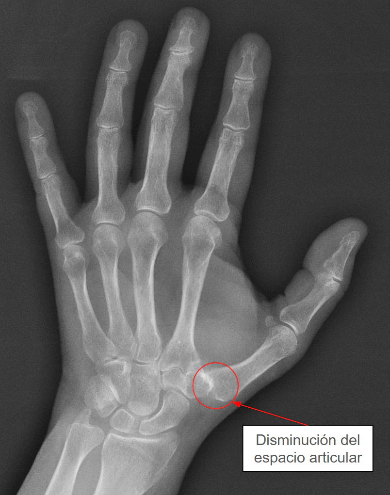 Radiografia de la mano que muestra rizartrosis con disminucion del espacio articular en la base del pulgar