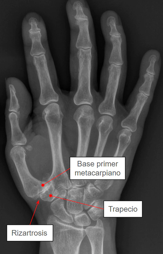 Radiografia que muestra signos de rizartrosis en el pulgar como disminución del espacio articular y esclerosis subcondral