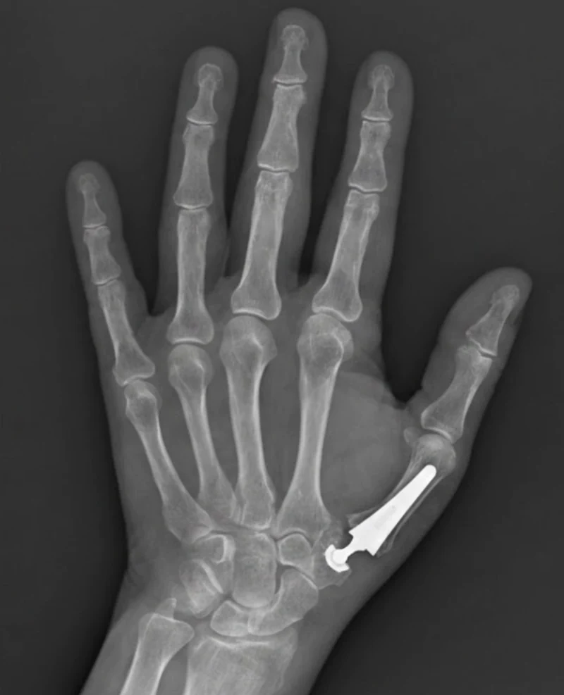 radiografia de protesis trapeciometacarpiana para el tratamiento de la rizartrosis de pulgar