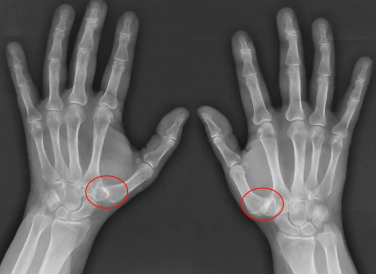 radiografia en ambas manos que muestra rizartrosis de los pulgares en un estado avanzado